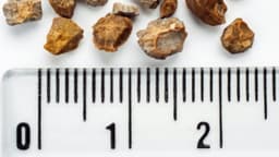 Sỏi thận 6mm có phải mổ không? Khi nào cần can thiệp?