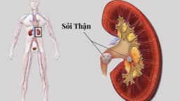 Sỏi thận 6mm có sao không? Có gây đau và biến chứng không?