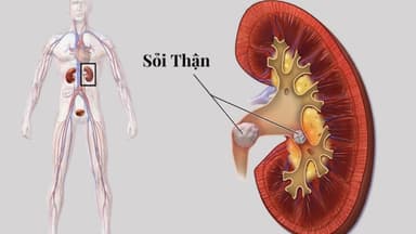 Sỏi thận 6mm có sao không? Có gây đau và biến chứng không?