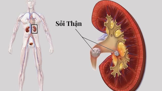 Sỏi thận 6mm có sao không? Có gây đau và biến chứng không?