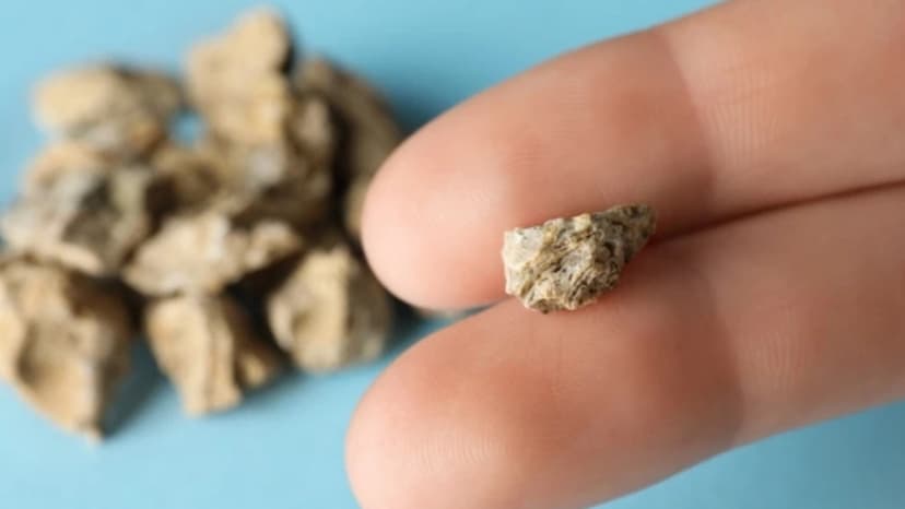 Sỏi thận 6mm ảnh hưởng ra sao? Khi nào có thể gây tắc nghẽn?