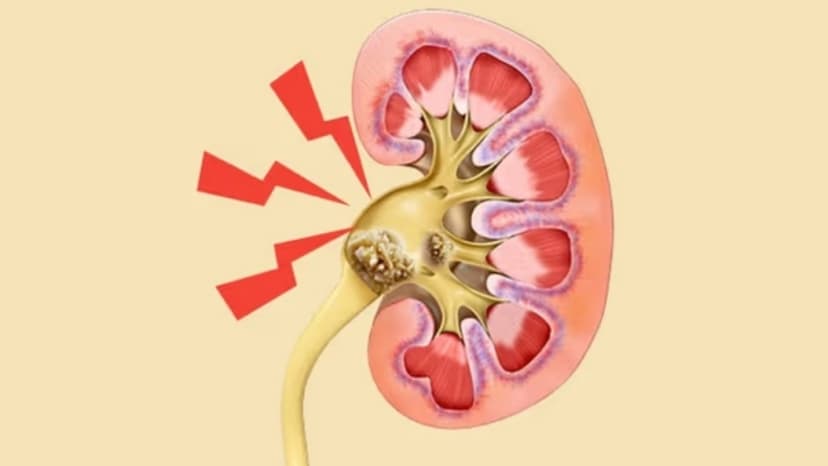 Sỏi thận 7mm có phải phẫu thuật không? Khi nào cần can thiệp?