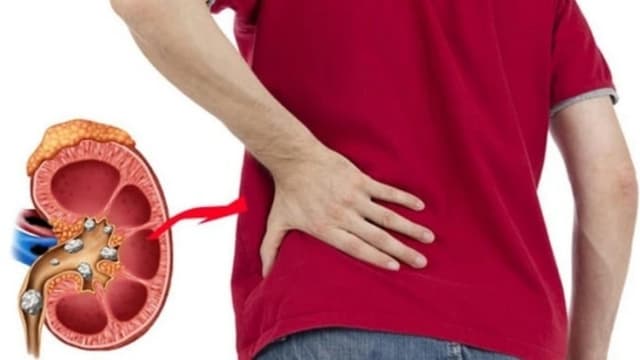 Sỏi thận là gì? Dấu hiệu nhận biết, cách chẩn đoán và hướng điều trị