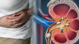 Sỏi san hô: Vì sao hình thành, có nguy hiểm không và điều trị thế nào?