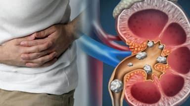 Sỏi san hô: Vì sao hình thành, có nguy hiểm không và điều trị thế nào?