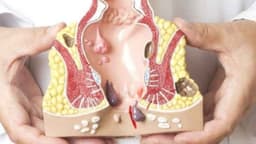 Trĩ nội độ 2: Dấu hiệu nhận biết, biến chứng và cách chữa