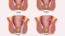 Trĩ nội độ 3: Dấu hiệu nhận biết, biến chứng và hướng điều trị