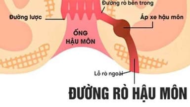 Rò hậu môn: Dấu hiệu nhận biết, chẩn đoán và hướng điều trị