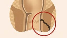 Rò hậu môn đơn giản: Dấu hiệu, kích thước, biến chứng và hướng điều trị