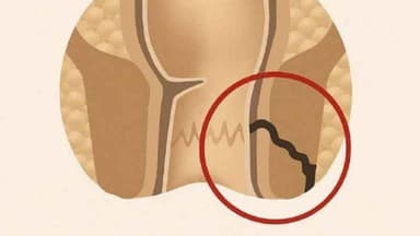 Rò hậu môn đơn giản: Dấu hiệu, kích thước, biến chứng và hướng điều trị