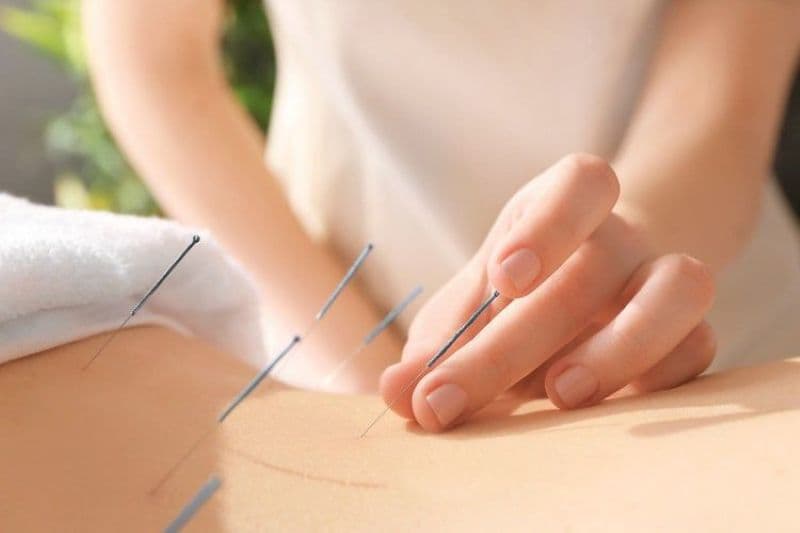 Châm cứu có thể hỗ trợ giảm đau, thư giãn cơ, cải thiện tuần hoàn và tê bì