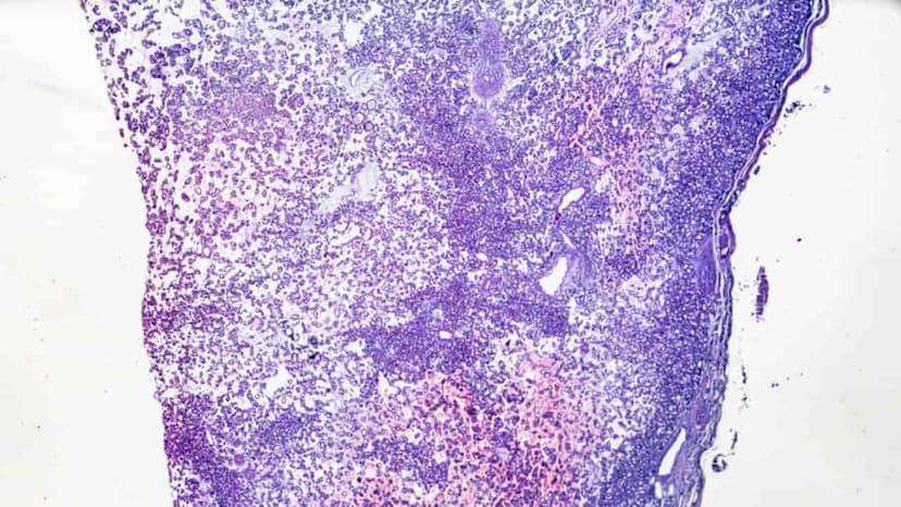 Adenoma ống nhung mao gây biến chứng gì? Cách điều trị và phòng ngừa ra sao?