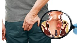 Áp xe quanh hậu môn là bệnh gì và có nguy hiểm không?