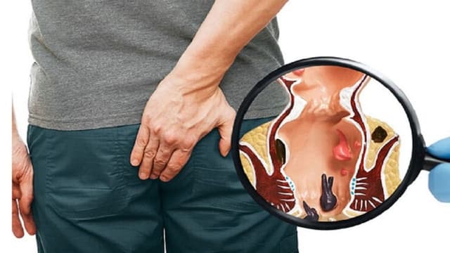 Áp xe quanh hậu môn là bệnh gì và có nguy hiểm không?