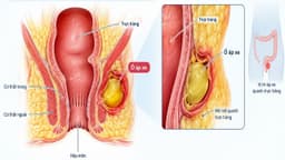 Áp xe quanh trực tràng là gì? Điều trị như thế nào?