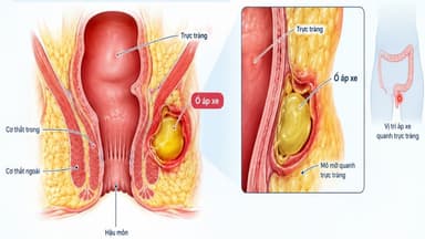 Áp xe quanh trực tràng là gì? Điều trị như thế nào?