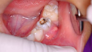 Áp xe răng: Dấu hiệu, nguyên nhân và cách điều trị