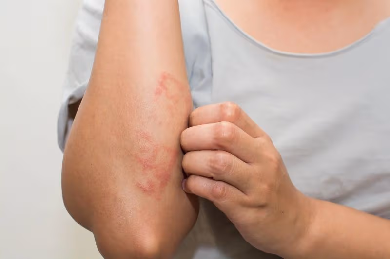 Viêm khớp dạng thấp gây nổi nốt thấp dưới da, đặc biệt ở khuỷu tay và các vùng chịu áp lực 
