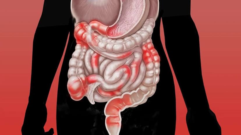 Bệnh Crohn là gì? Nguyên nhân, triệu chứng, chẩn đoán và điều trị