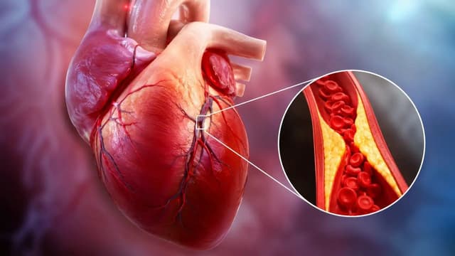 Nguyên nhân, biến chứng và cách điều trị bệnh mạch vành