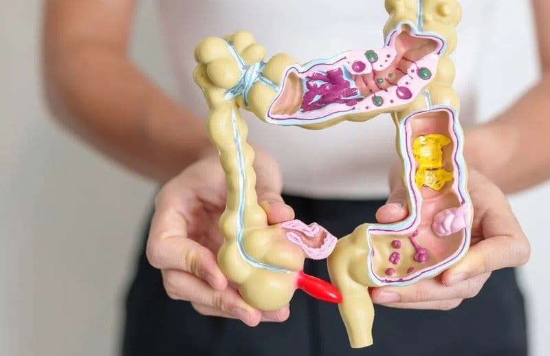 Điều trị áp xe ruột thừa cần căn cứ vào kích thước ổ áp xe và mức độ nhiễm trùng