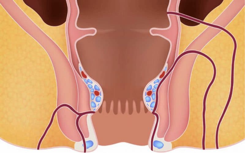 Áp xe trực tràng là bệnh lý có thể gây ra nhiều biến chứng nguy hiểm