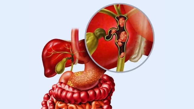Biến chứng của sỏi ống mật chủ là gì? Có nguy hiểm không?