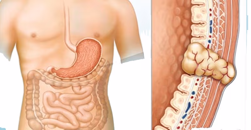 GIST dạ dày là một trong những loại khối u trung mô hiếm gặp