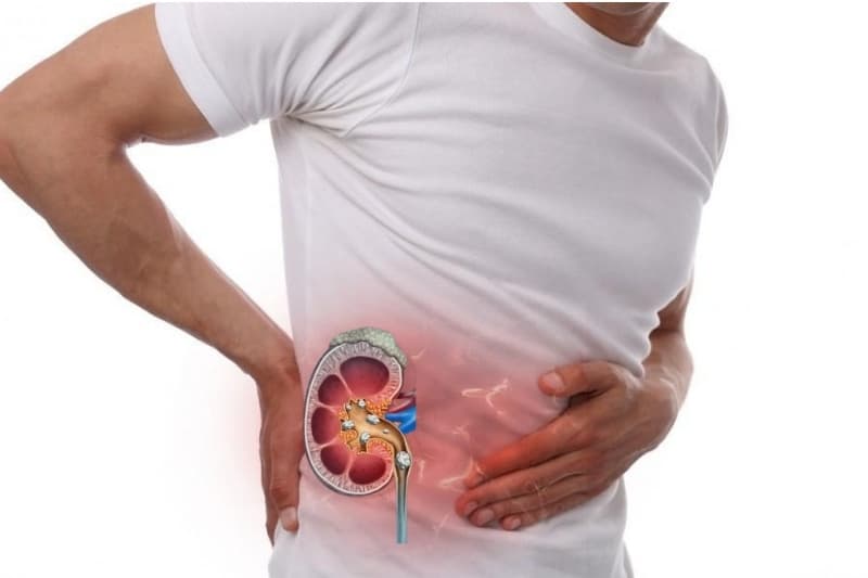 Sỏi hình thành trong hệ tiết niệu sẽ gây ra nhiều cơn đau quặn thắt vùng lưng và mạn sườn