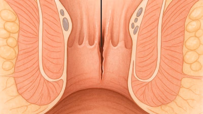 Nứt kẽ hậu môn mạn nếu không được điều trị đúng cách có thể gây đau kéo dài, ảnh hưởng đến sinh hoạt và làm tăng nguy cơ tổn thương khó lành
