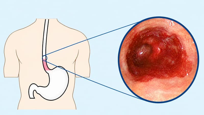 Polyp thực quản có thể gây chảy máu rỉ rã kéo dài