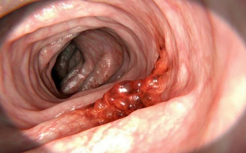 Một số polyp trực tràng có nguy cơ tiến triển thành ung thư theo thời gian 