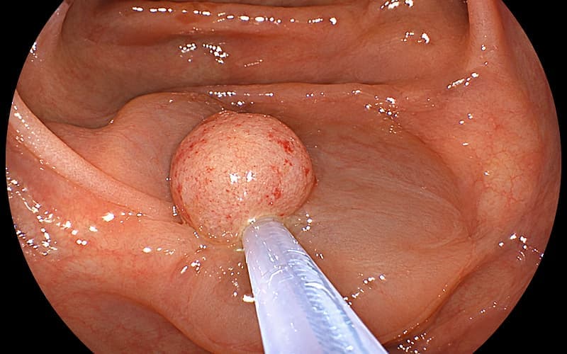 Polyp có kích thước càng lớn thì nguy cơ càng cao