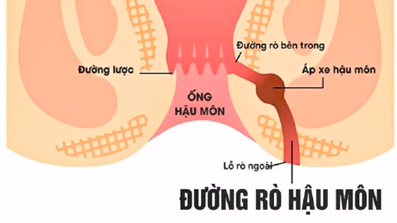 Rò hậu môn là một đường hầm nhỏ bất thường nối liền giữa tuyến bị nhiễm trùng bên trong ống hậu môn với vùng da bên ngoài