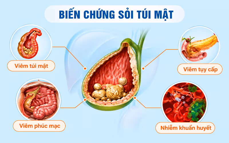 Một số biến chứng sỏi túi mật nguy hiểm