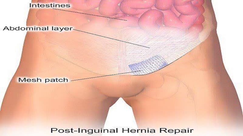Biến chứng thoát vị bẹn tái phát