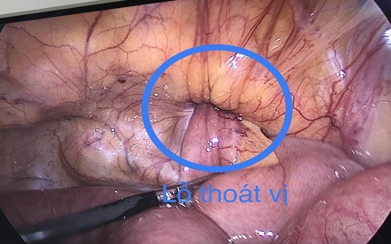 Thoát vị bịt có thể gây hoại tử ruột nếu không điều trị kịp thời