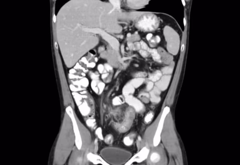 Chụp CT giúp chẩn đoán chính xác thoát vị cạnh hậu môn nhân tạo