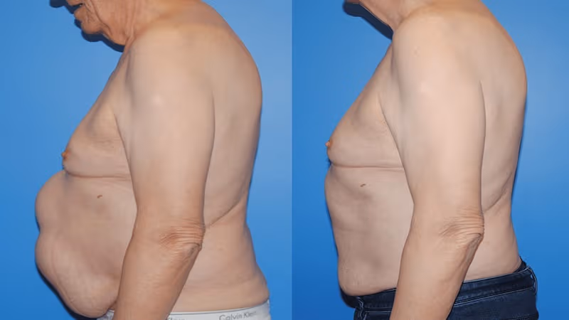 Thoát vị vết mổ có thể gây nghẹt ruột do quai ruột bị mắc kẹt