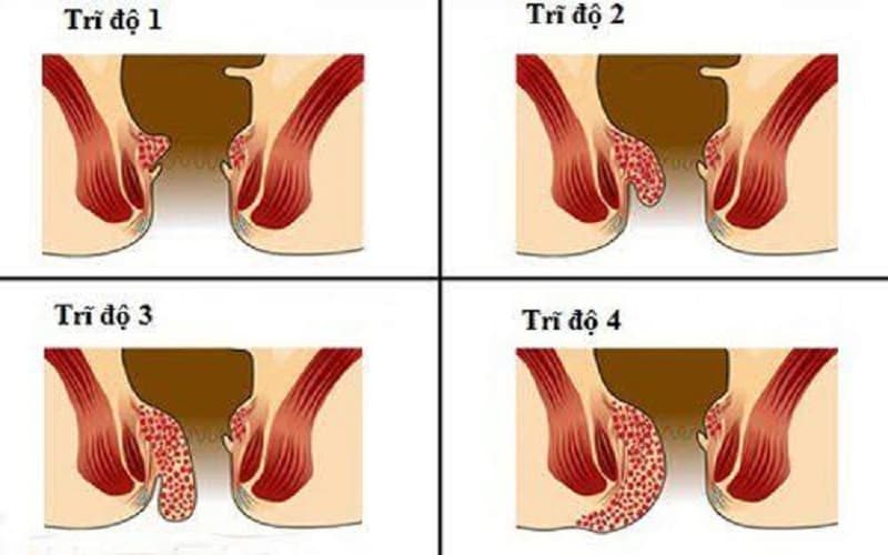 Y khoa phân loại tiến triển của bệnh trĩ nội thành 4 cấp độ