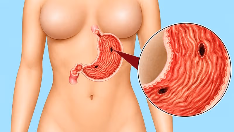 Thủng dạ dày là biến chứng rất nguy hiểm