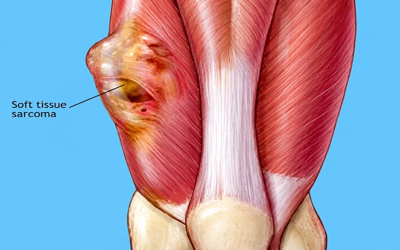 U mô mềm có thể mang bản chất ác tính