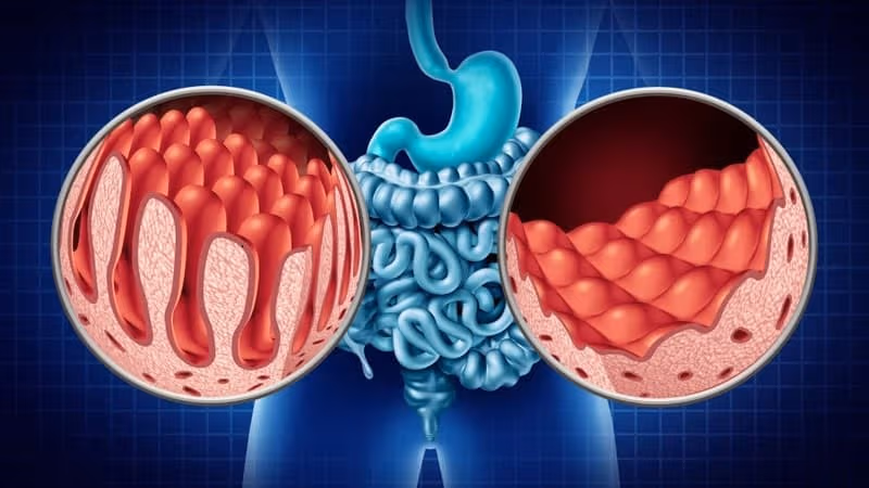 Thủng ruột do viêm đại tràng rất nguy hiểm