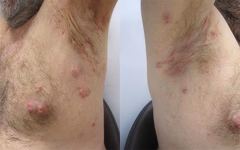 Viêm tuyến mồ hôi mủ xuất hiện dưới nách