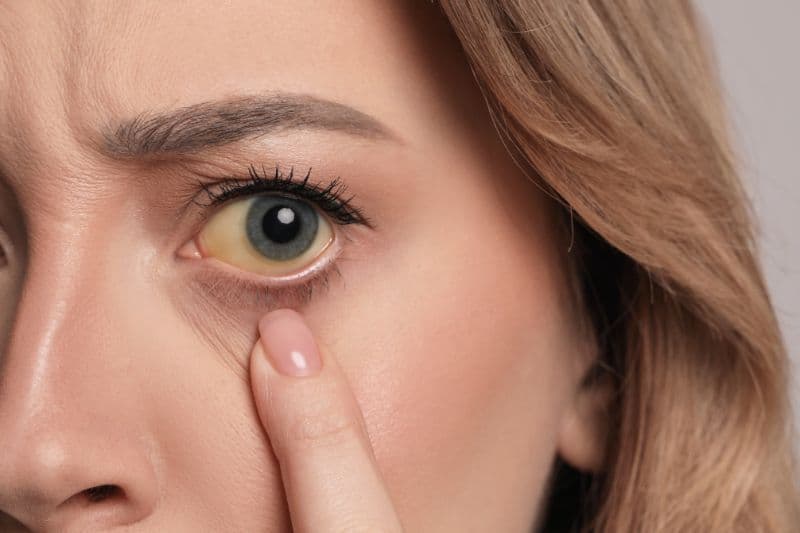 Vàng da, vàng mắt là những dấu hiệu nhận diện xơ gan cần lưu ý.