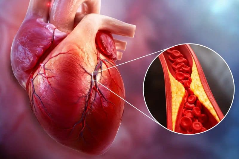 Bệnh mạch vành là tình trạng động mạch cung cấp máu cho cơ tim bị hẹp hoặc tắc nghẽn, khiến lượng máu và oxy đến cơ tim suy giảm.