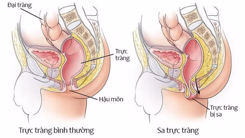 Chữa sa trực tràng cần dựa trên mức độ bệnh và tình trạng sức khỏe của từng người