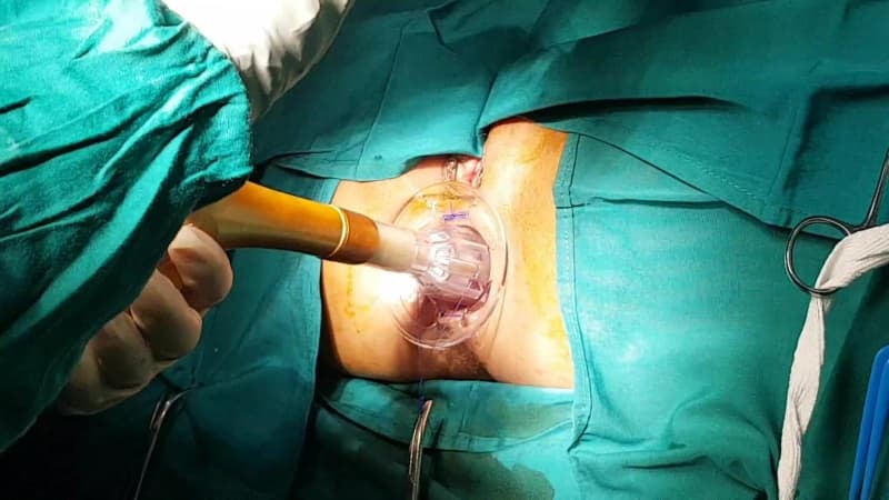 Phẫu thuật trĩ hỗn hợp tắc mạch