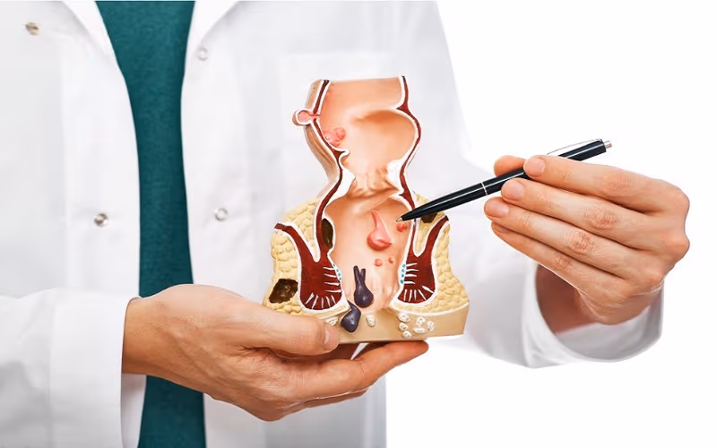 Trĩ hỗn hợp là bệnh lý xảy ra khi búi trĩ nội và trĩ ngoại cùng xuất hiện ở một người