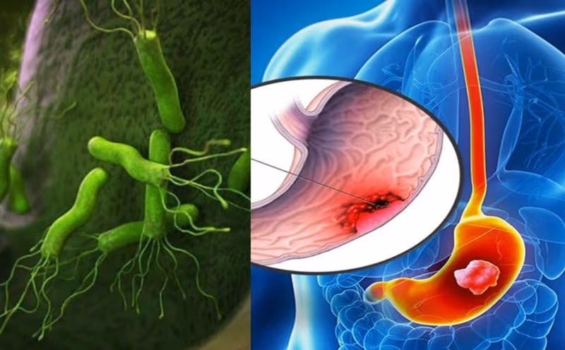 Viêm dạ dày ruột là tình trạng viêm xảy ra ở dạ dày và ruột